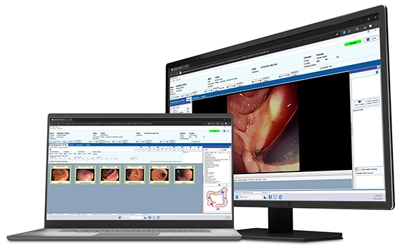 A laptop and computer monitor showing EndoVault image capture and Argus image capture software respectively. Medical Imaging Software